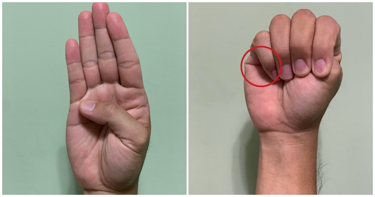 醫師分享一個動作可自我檢測是否為主動脈剝離的好發族群。（本刊資料照）