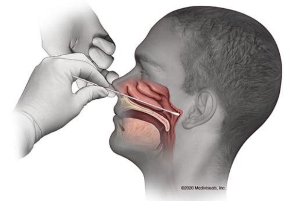 武漢肺炎的鼻咽檢測需用棉棒插入鼻腔底部採樣,許多人看畫面感到怵目驚心。(示意圖,翻攝自推特@DrPeckPNP)