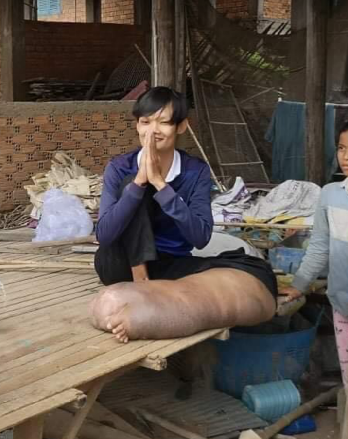 邦特的腳腫脹成一般人5倍大小,造成生活嚴重不便。(圖源:ទ្រី ដាណា Dana Try臉書)