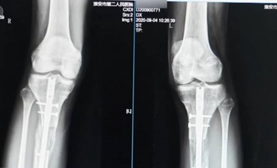 少男斷骨增高不成，反而引發骨髓炎恐因此終身殘疾。（翻攝自《央視》官網影片）