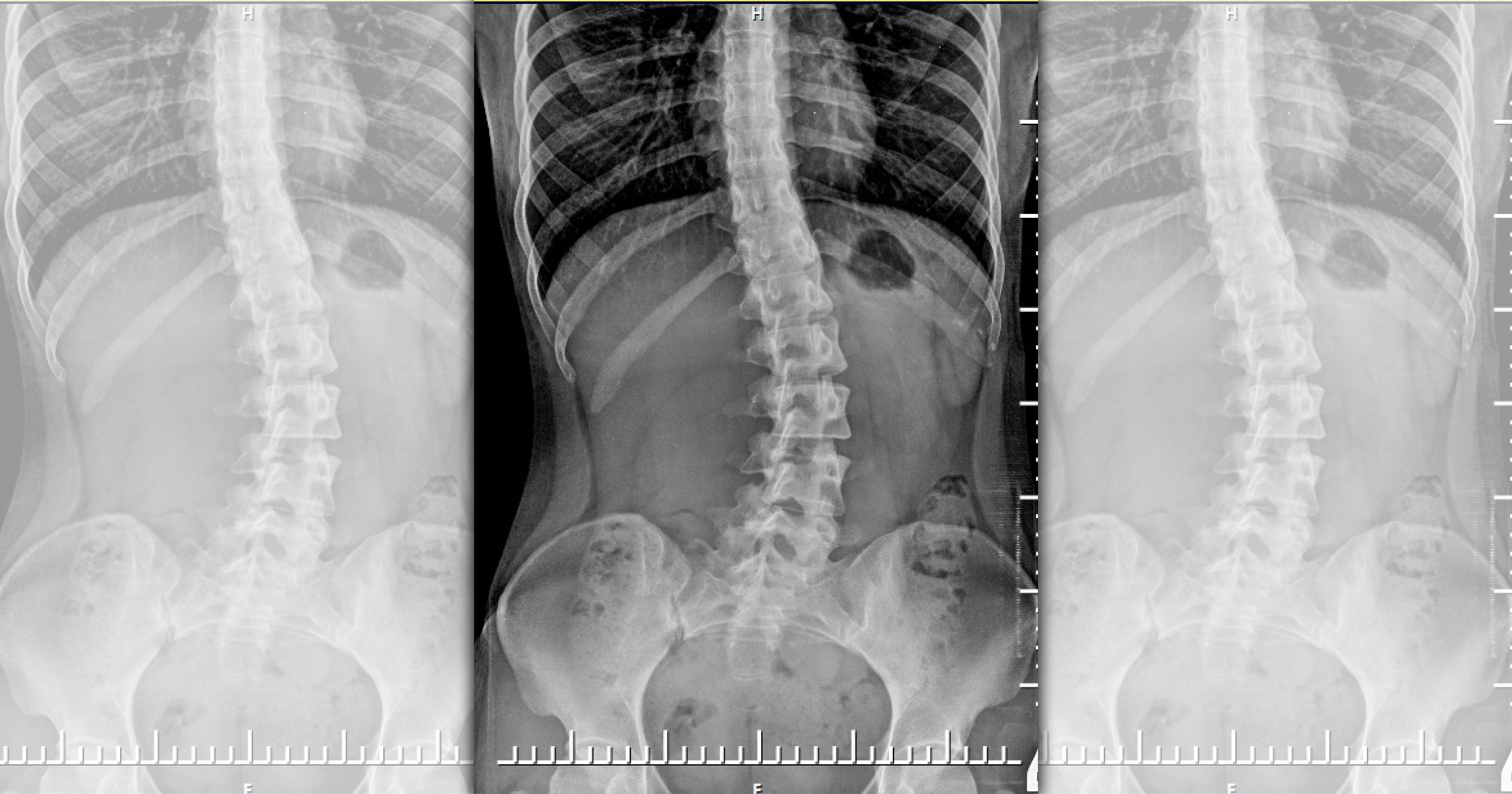 脊椎側彎是青少年常見的疾病，醫師建議家長尋求醫師幫助，盡早發現盡早治療，以免影響孩子的生長發育。示意圖，圖非當事人X光。（讀者提供）