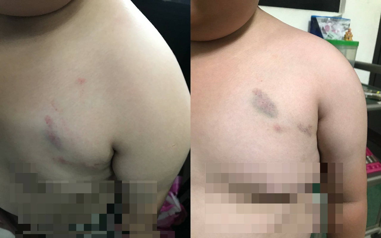 一名家長在網路發文指出，日前兒子身上出現紅腫瘀傷，懷疑幼兒園不當管教。（翻攝自靠北惡質幼兒園臉書）