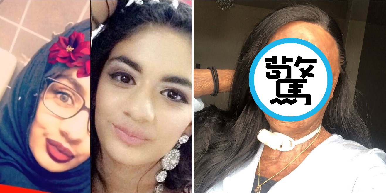 英國少女艾利瑪12歲那年意外成為燒燙傷病友。（翻攝自IG／aleemaxali）