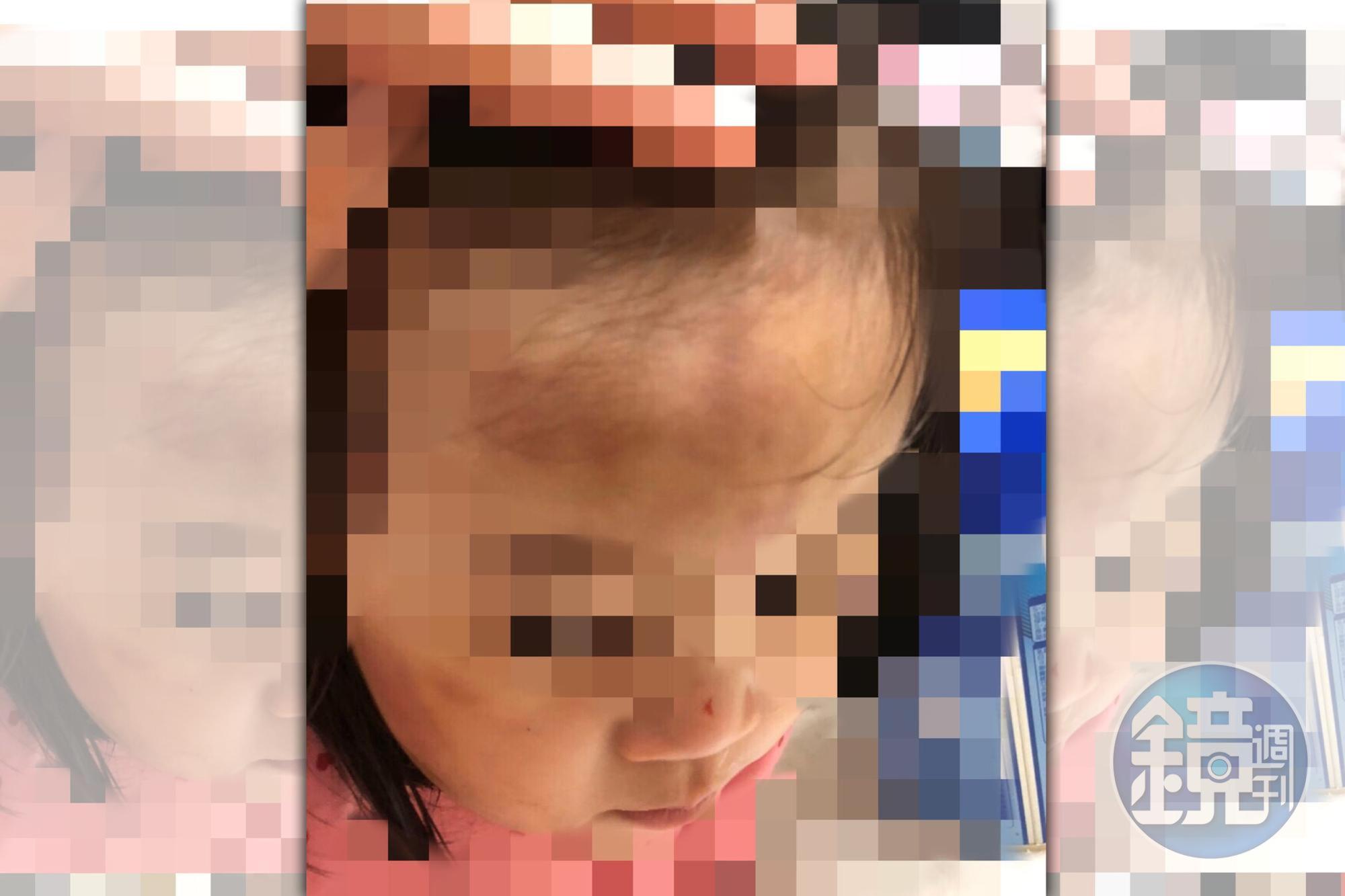 A先生控訴女兒被吳姓保母照顧後,額頭出現大面積瘀傷。(讀者提供)