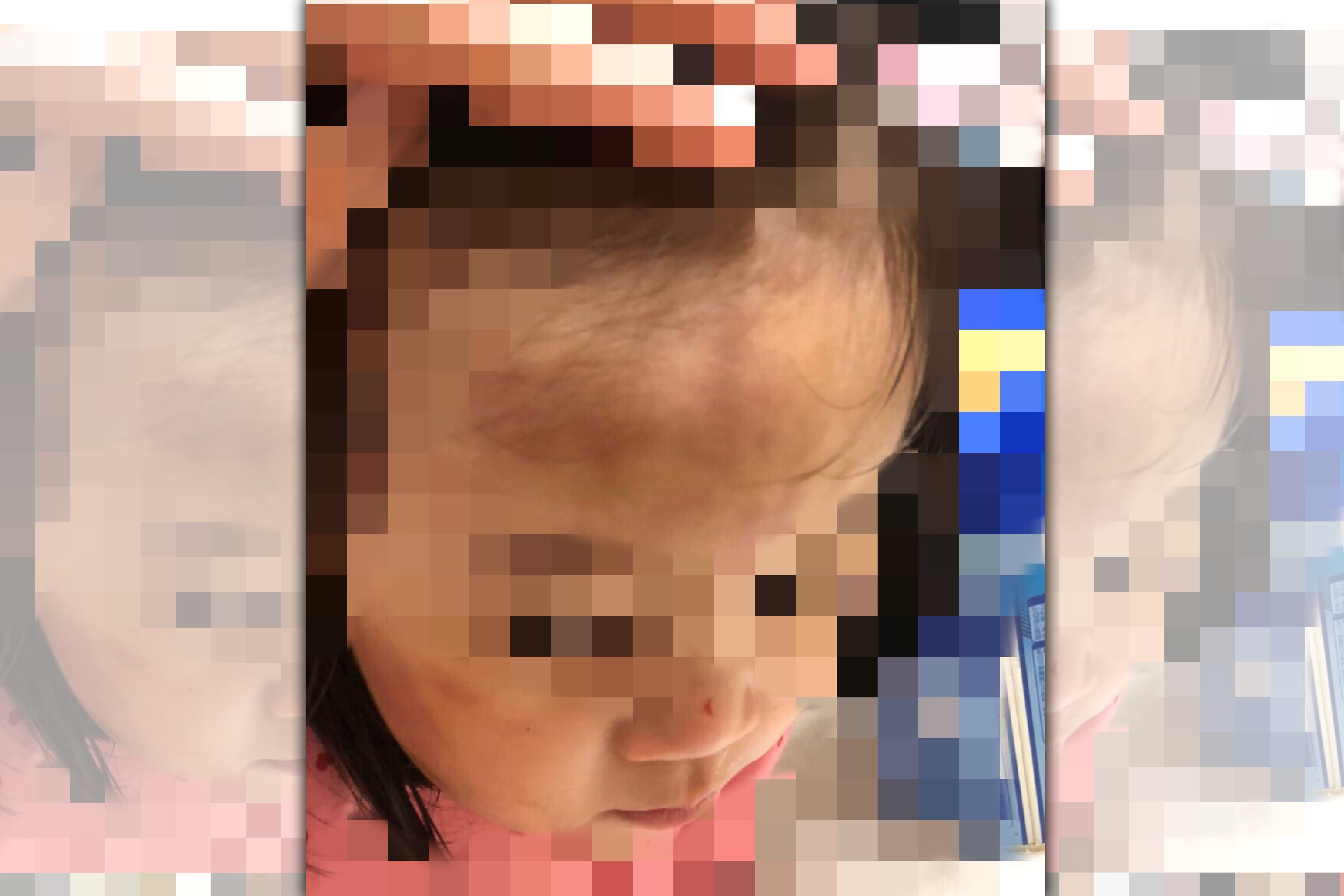 A先生控訴女兒被吳姓保母照顧後，額頭出現大面積瘀傷。（讀者提供）