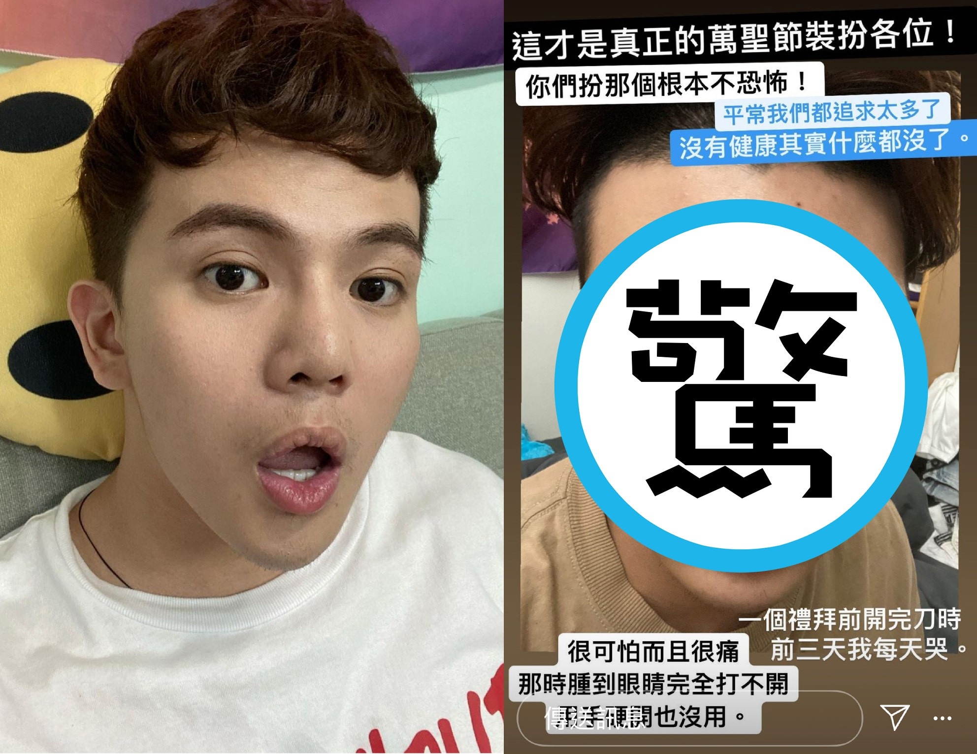 孫生日前身體出現異狀，臉部浮腫宛如遭到拳擊手海扁。（翻攝自孫生IG）