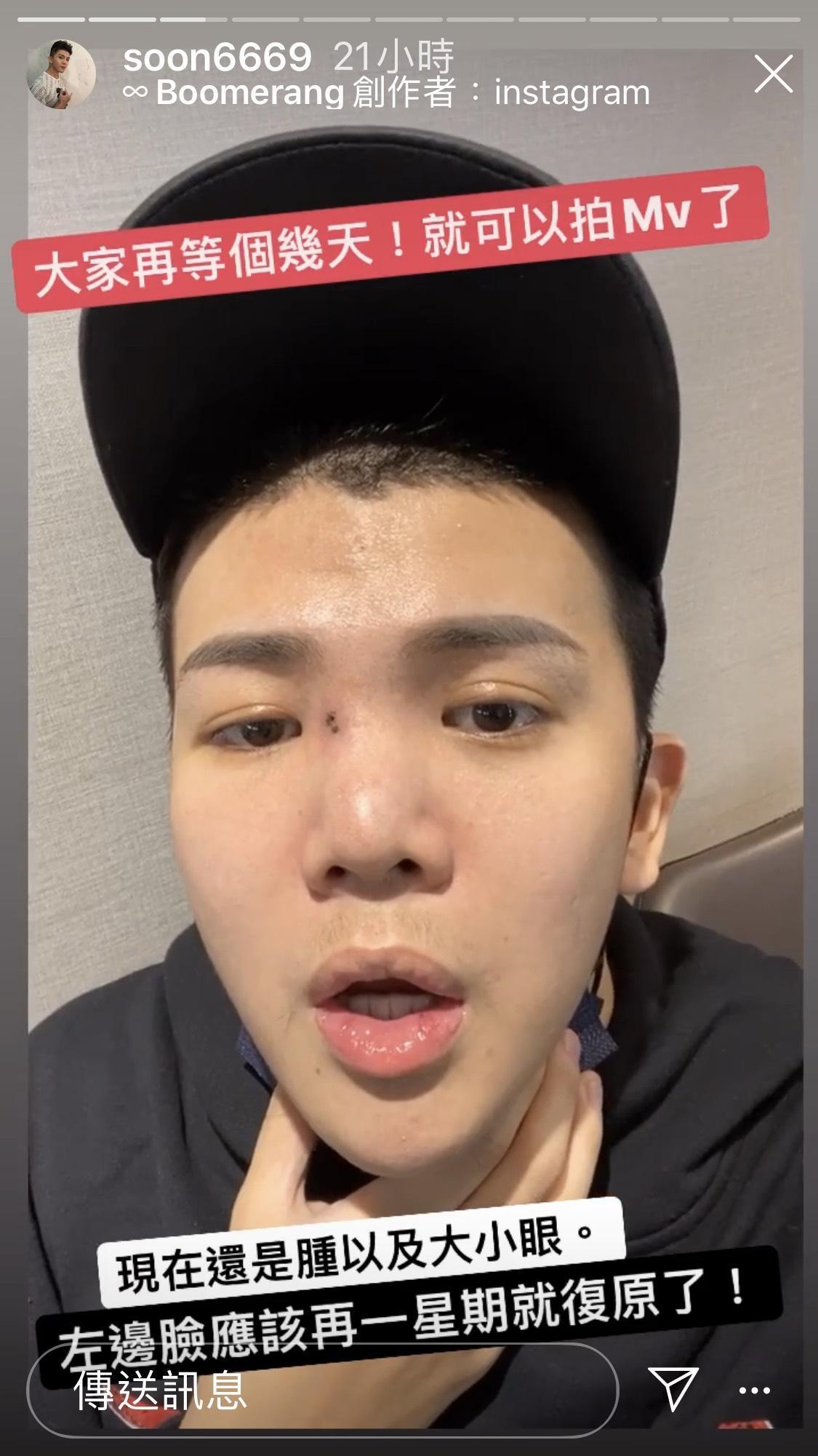 孫生接受開刀治療後已趨於穩定，僅剩左半臉還些許浮腫。（翻攝自孫生IG）