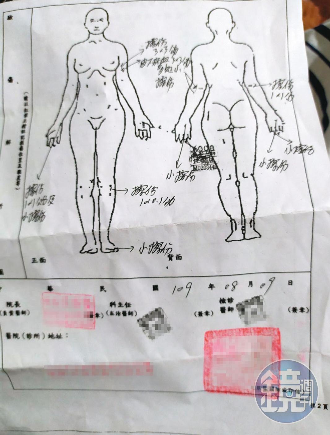 被害人H小姐事後赴醫院驗傷,並對男友提出傷害告訴。(讀者提供)
