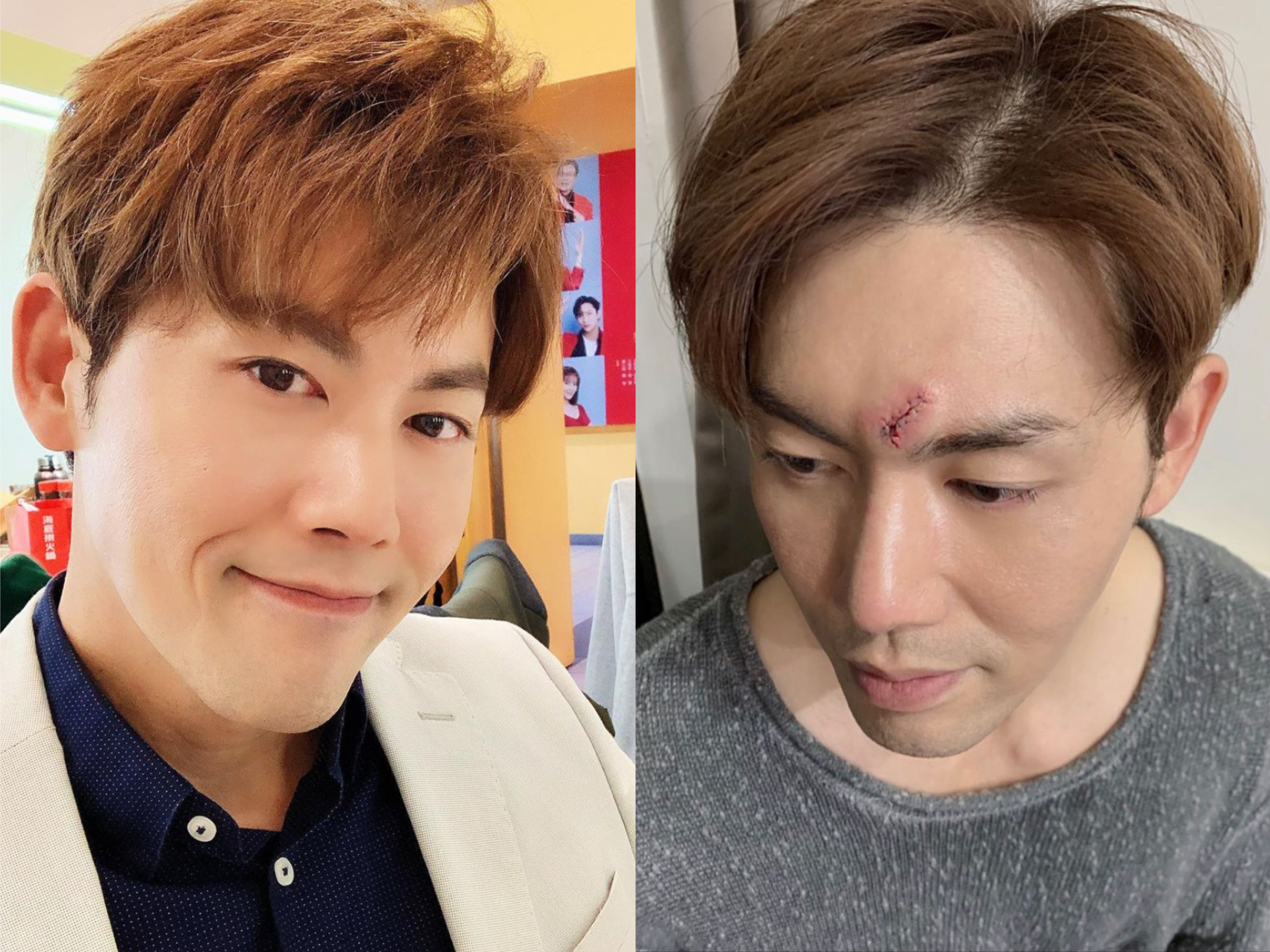 余秉諺昨日不小心撞上玻璃，額頭當場見血，神奇的是玻璃竟然沒破。（翻攝自余秉諺IG）