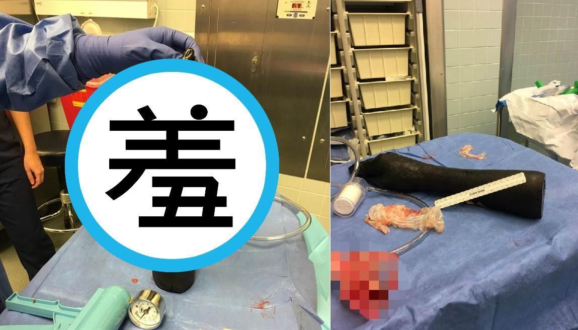 醫生從病患肛門拔出巨大異物,當場傻眼。(翻攝自VK)