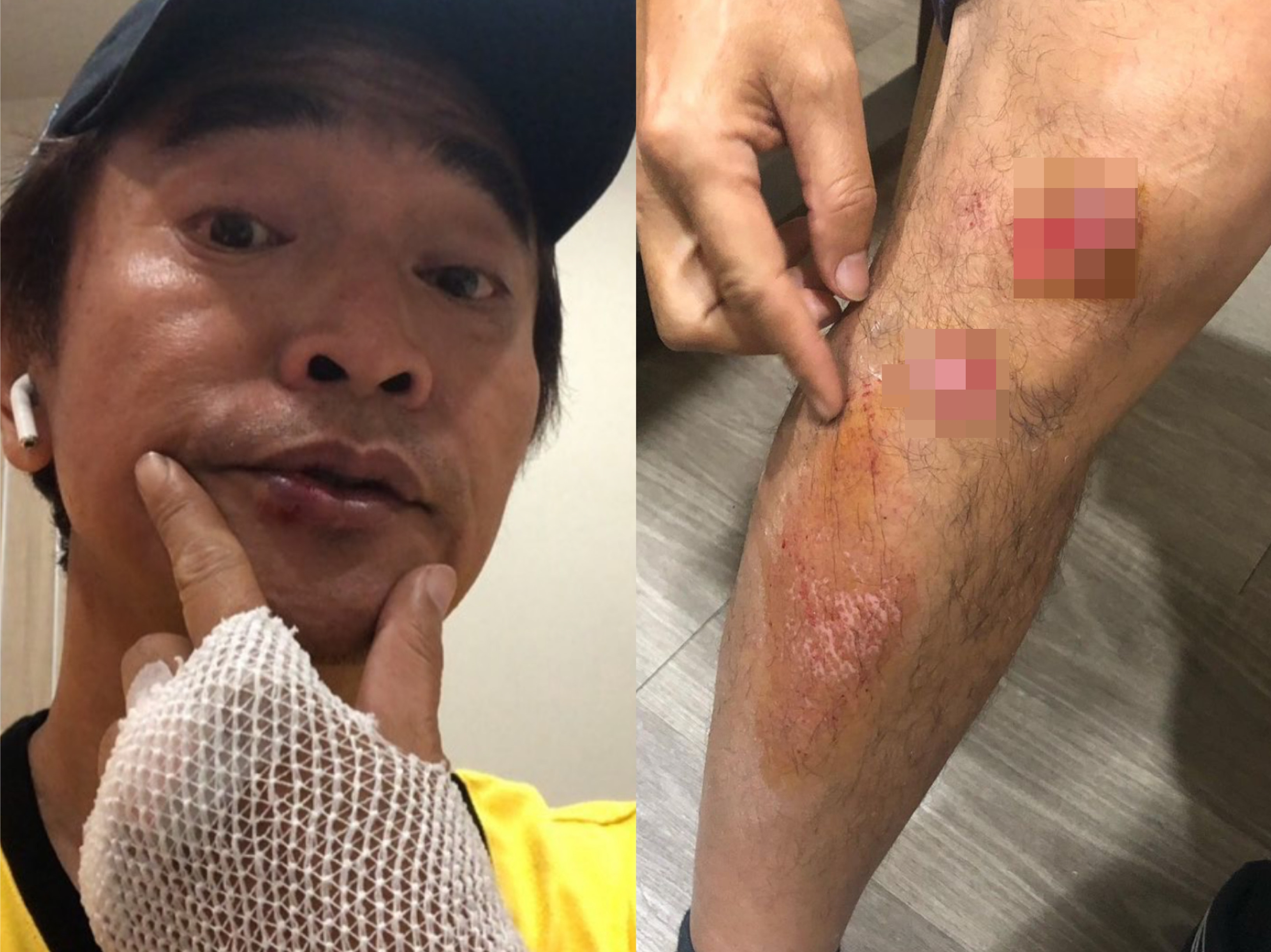 吳宗憲錄製《綜藝玩很大》，闖關過程中摔車，全身多處擦挫傷。（翻攝自吳宗憲IG）