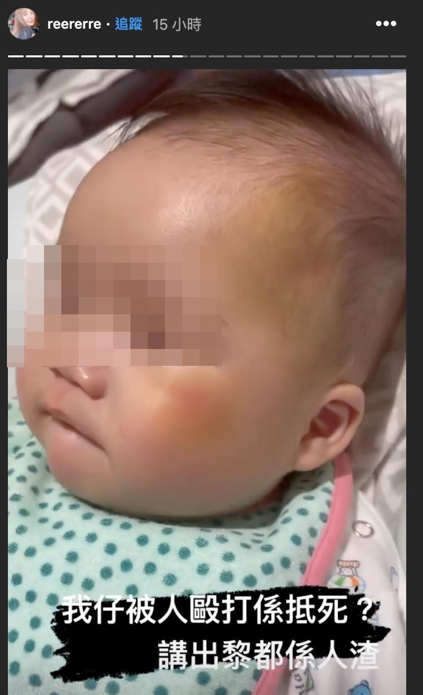 從影片可以看出,孩子左臉太陽穴及臉頰都有大片瘀青,痛得哭泣。(翻攝自蘇淼淼IG)