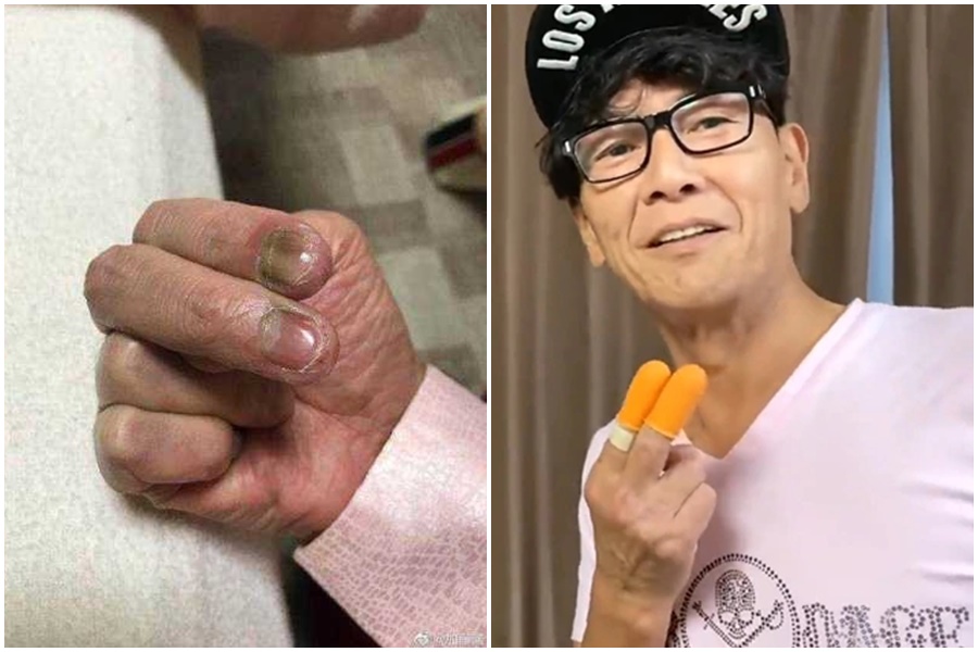 加藤鷹食指、中指竟出現潰爛,指甲甚至還呈灰色。(翻攝自YouTube/加藤鷹推特)