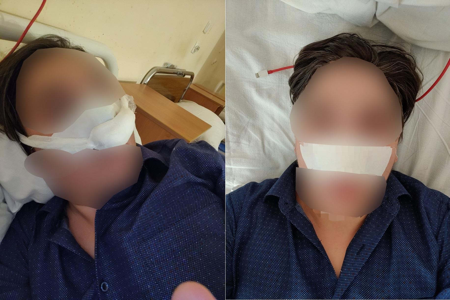 男子幸運接回斷鼻。（翻攝自《fontanka.ru》）