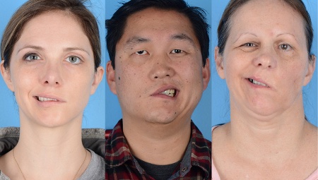 美國有4人在施打輝瑞疫苗之後，出現臉歪嘴斜的症狀。（翻攝自@o_rips twitter）