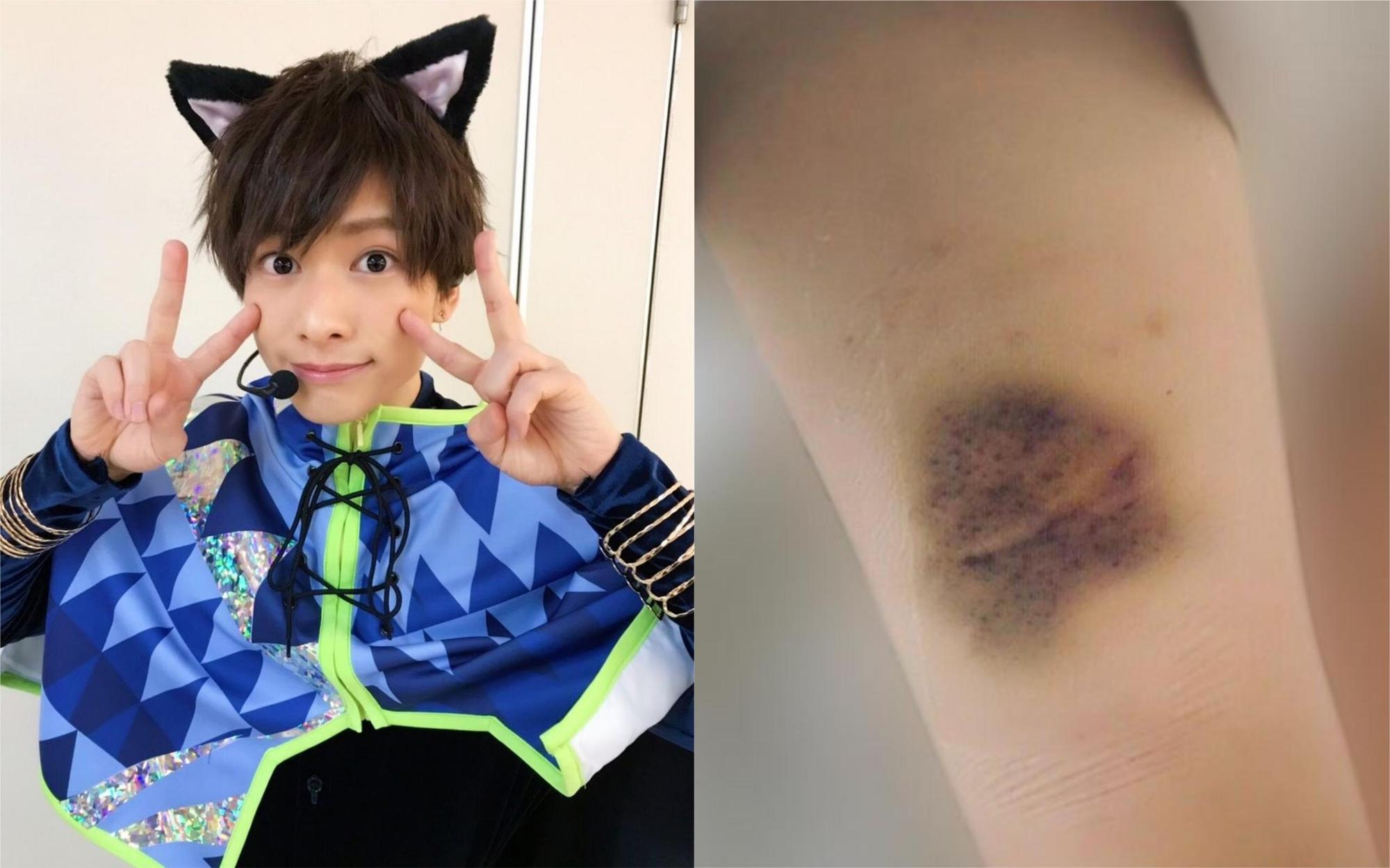 小澤廉（左圖）遭踢爆長年對女友施暴，女友身上各處都出現瘀青。（左圖翻攝小澤廉Twitter，右圖翻攝自《週刊文春》）