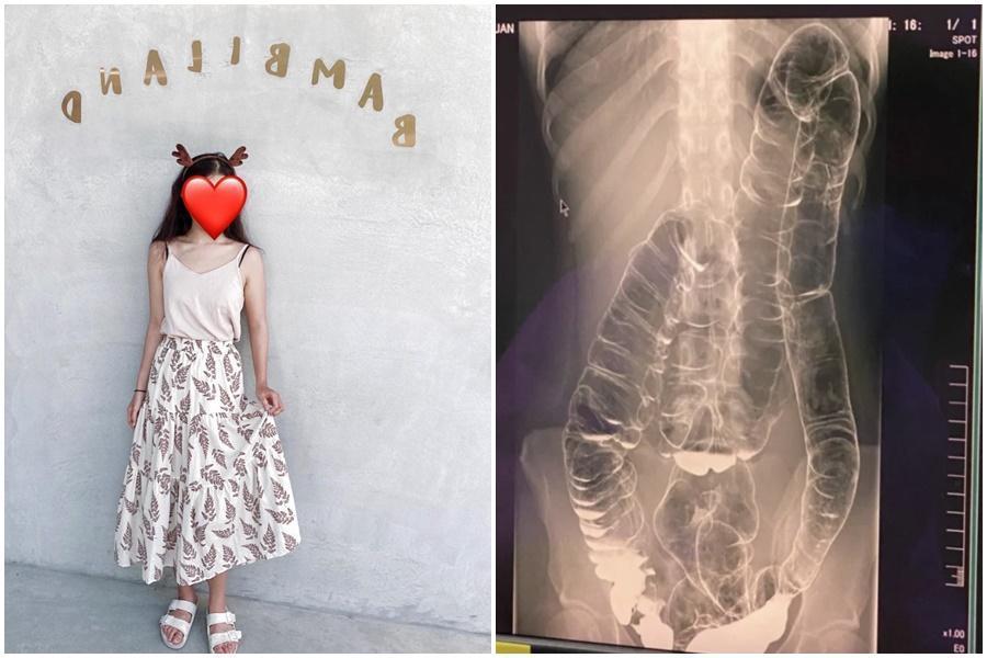 女網友在Dcard透露從小受便祕所苦,照了X光才驚覺大腸竟已擠壓到接近胸腔位置。(翻攝自Dcard、當事人授權)