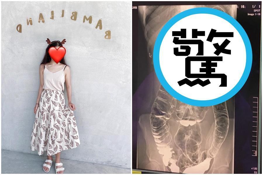 女網友在Dcard透露從小受便祕所苦,照了X光才驚覺大腸竟已擠壓到接近胸腔位置。(翻攝自Dcard、當事人授權)