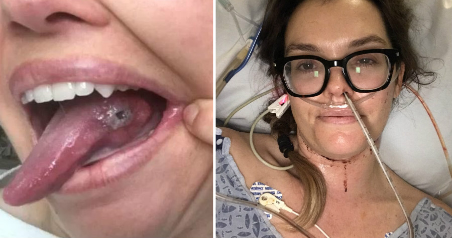 潔咪睡醒發現自己咬傷舌頭,醫生卻診斷是舌癌,並已擴散到淋巴結與神經系統,最後她在醫生的安排下,進行部分舌切與頸部解剖手術。(翻攝自headandneck.org)