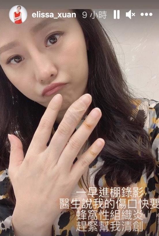 璟宣自曝醫生幫做傷口清創太痛，讓整個梳化間充滿她的慘叫聲。（翻攝自璟宣IG）