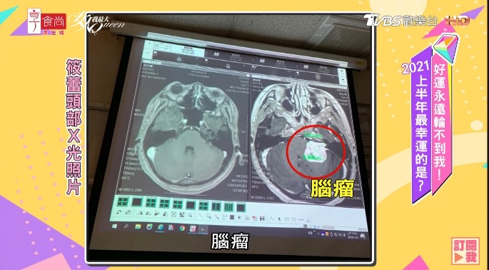 筱蕾在節目上分享發現腦瘤的經過。(翻攝自《女人我最大》YouTube)