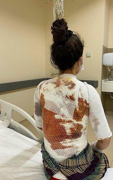 阿里不滿被盧琪亞打斷睡眠，竟拿滾燙開水朝她的頸部倒下，導致盧琪亞背部脫一層皮。  （翻攝Twitter）