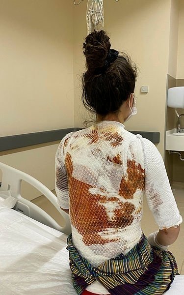 阿里不滿被盧琪亞打斷睡眠，竟拿滾燙開水朝她的頸部倒下，導致盧琪亞背部脫一層皮。  （翻攝Twitter）