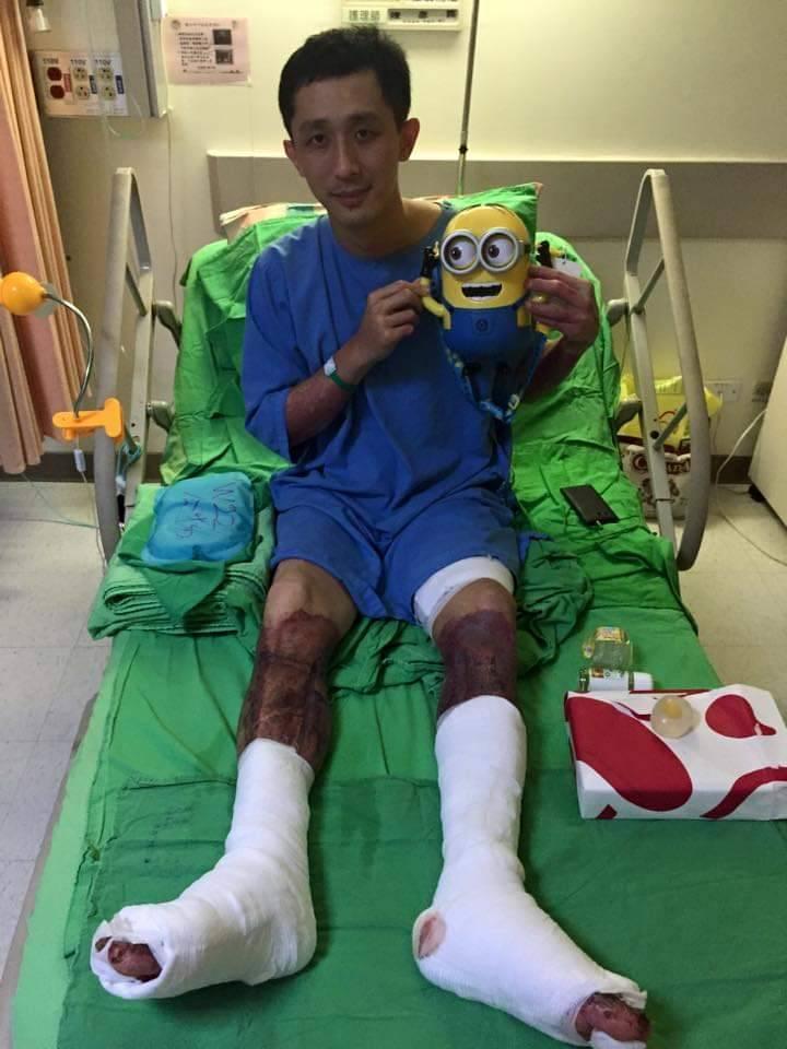 曾是八仙塵爆傷者之一,蔡豐燦四肢特別是雙腿有大面積嚴重燒燙傷,在歷經長達2個多月的植皮治療過程,「打針」對他曾是一大夢魘。(慈濟基金會提供)