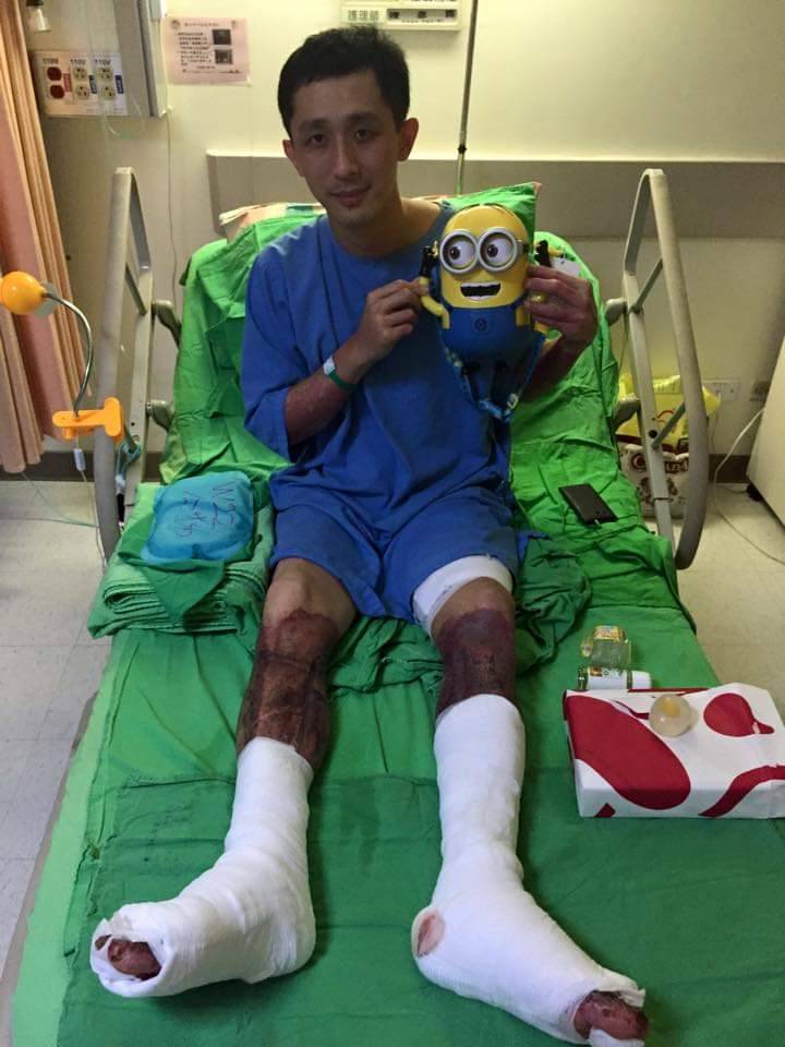 曾是八仙塵爆傷者之一，蔡豐燦四肢特別是雙腿有大面積嚴重燒燙傷，在歷經長達2個多月的植皮治療過程，「打針」對他曾是一大夢魘。（慈濟基金會提供）