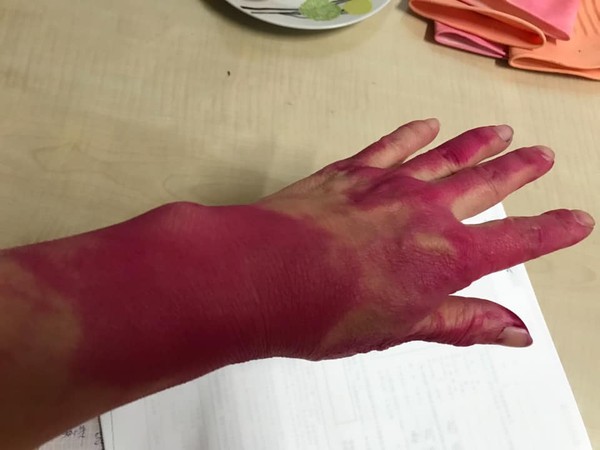 被染色的部位怎麼洗都洗不乾淨,網友趕緊帶家人就醫。(翻攝自爆廢公社臉書)