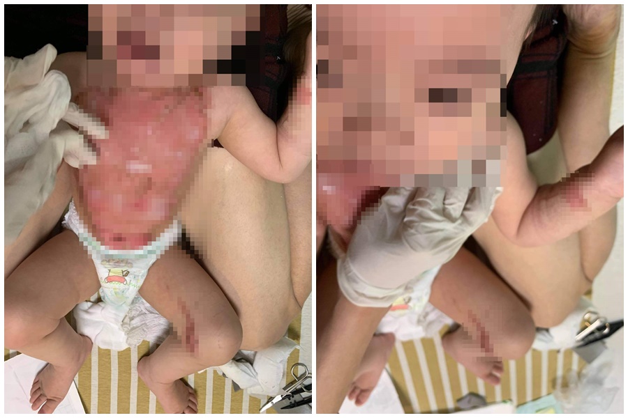 女嬰被滾燙熱水淋滿胸口，皮開肉綻的傷勢令人感到怵目驚心。（民眾提供）
