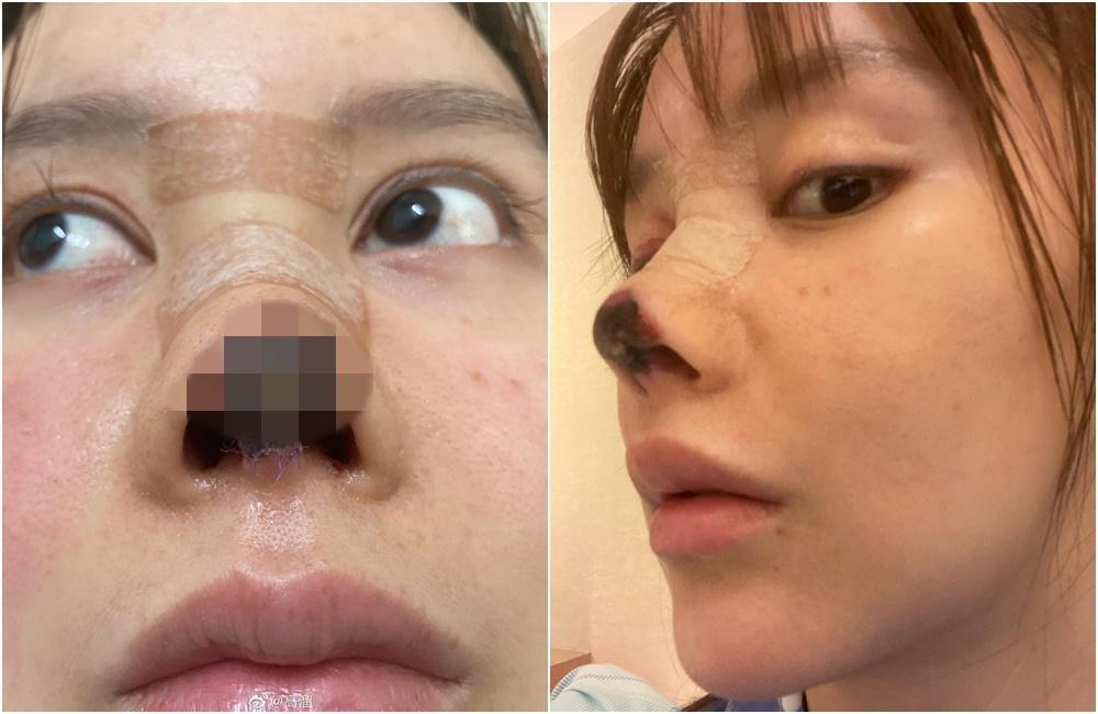 高溜公開手術後照片。(翻攝高溜微博,照片經馬賽克處理)