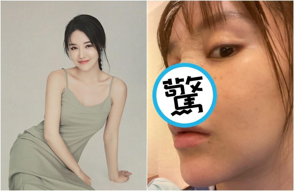 高溜近日在微博自爆整形失敗,鼻子發黑、組織壞死。(翻攝高溜微博)
