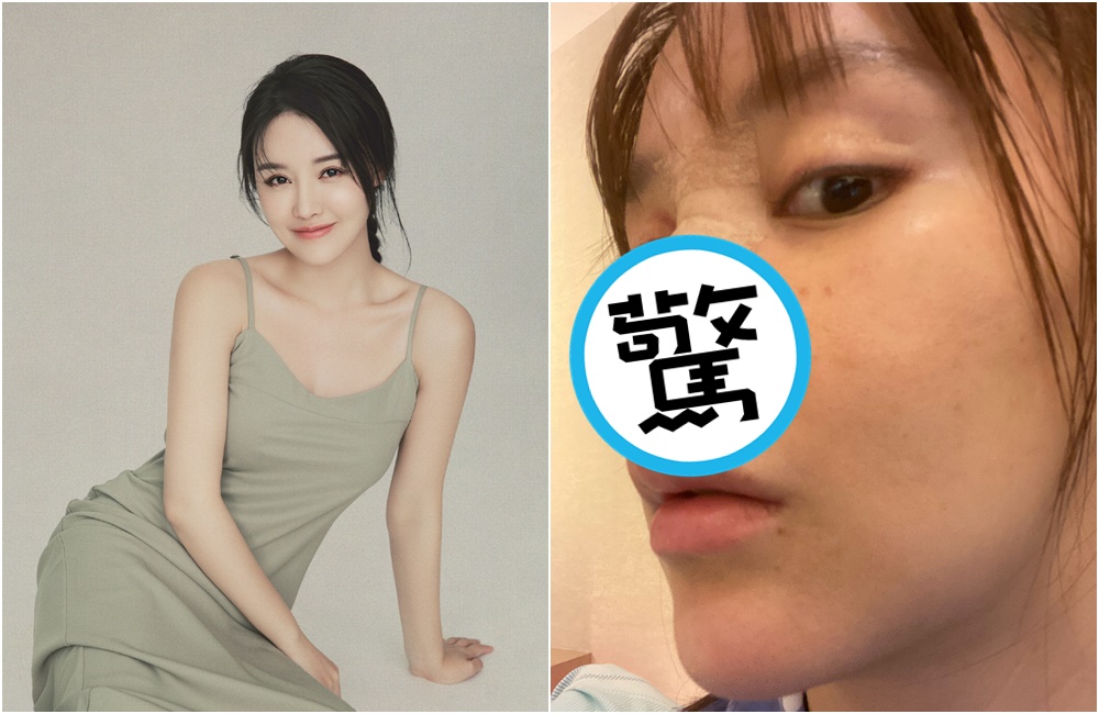 高溜近日在微博自爆整形失敗，鼻子發黑、組織壞死。（翻攝高溜微博）