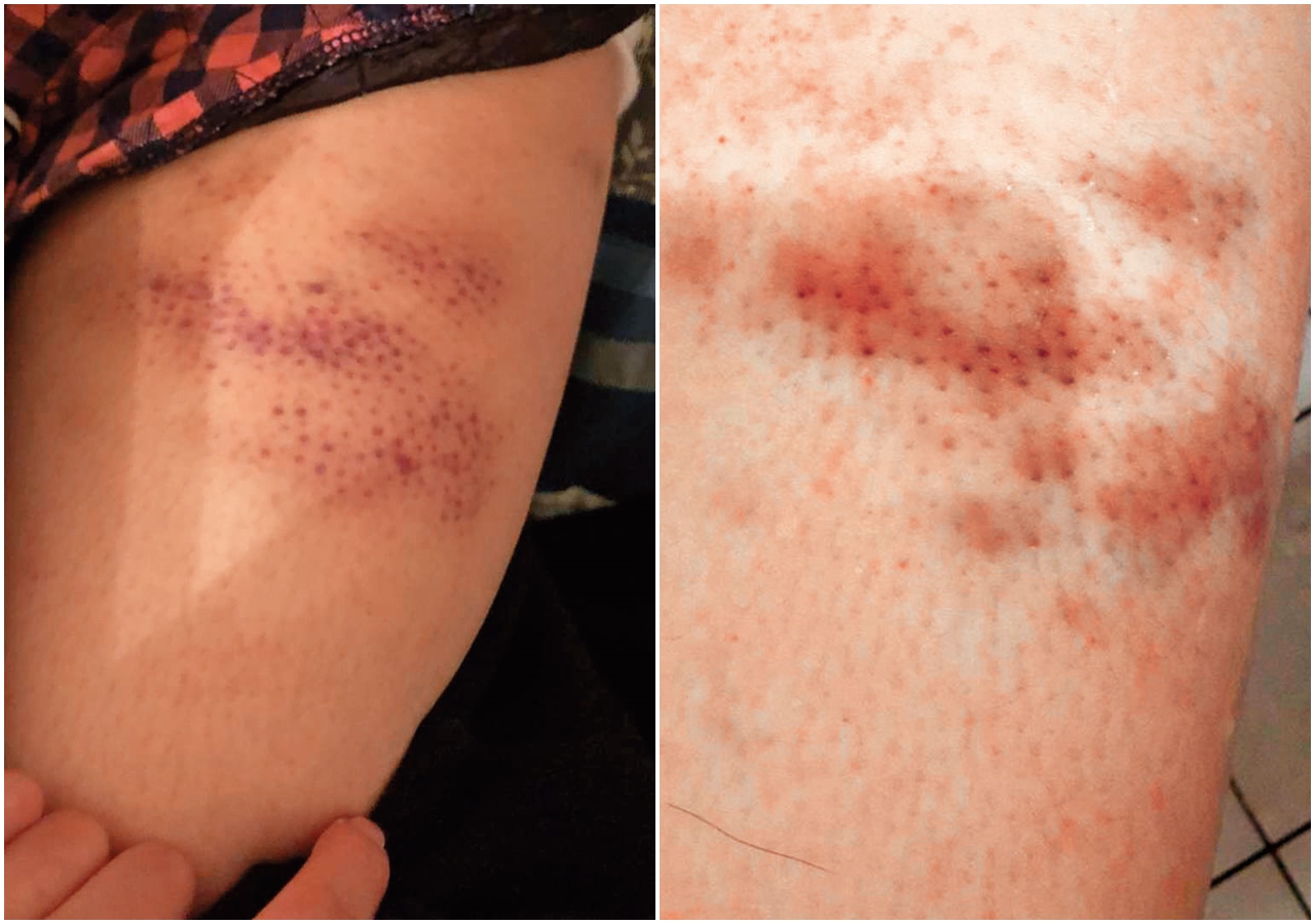 患有自閉症的小方無法像一般人說話，疑似在護理之家遭虐打，只能在夜晚哭泣發洩情緒。（讀者提供）