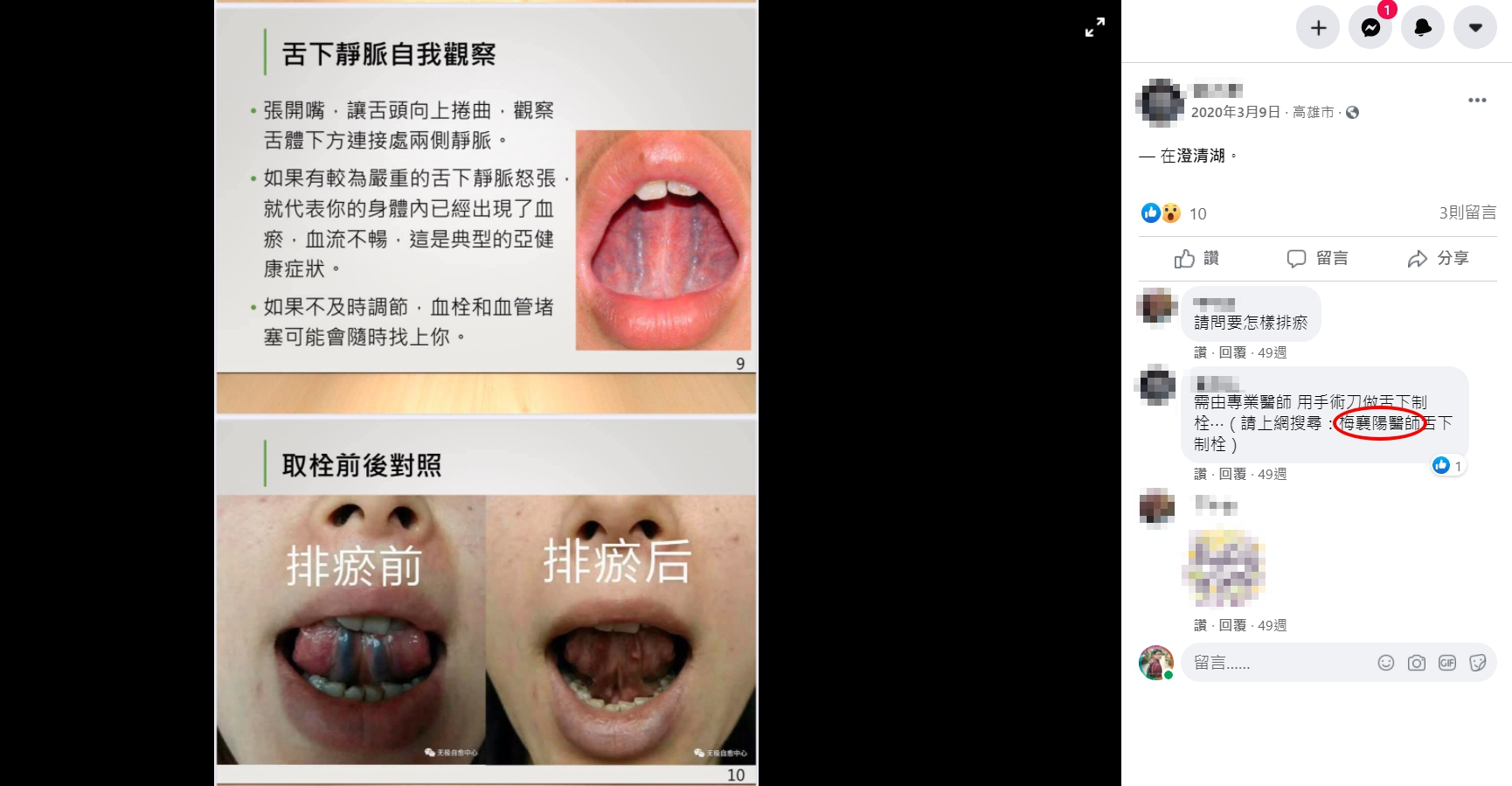 有網友於臉書分享「舌下取栓」,甚至還推薦民眾可以上網搜尋梅襄陽醫師。(翻攝自臉書)
