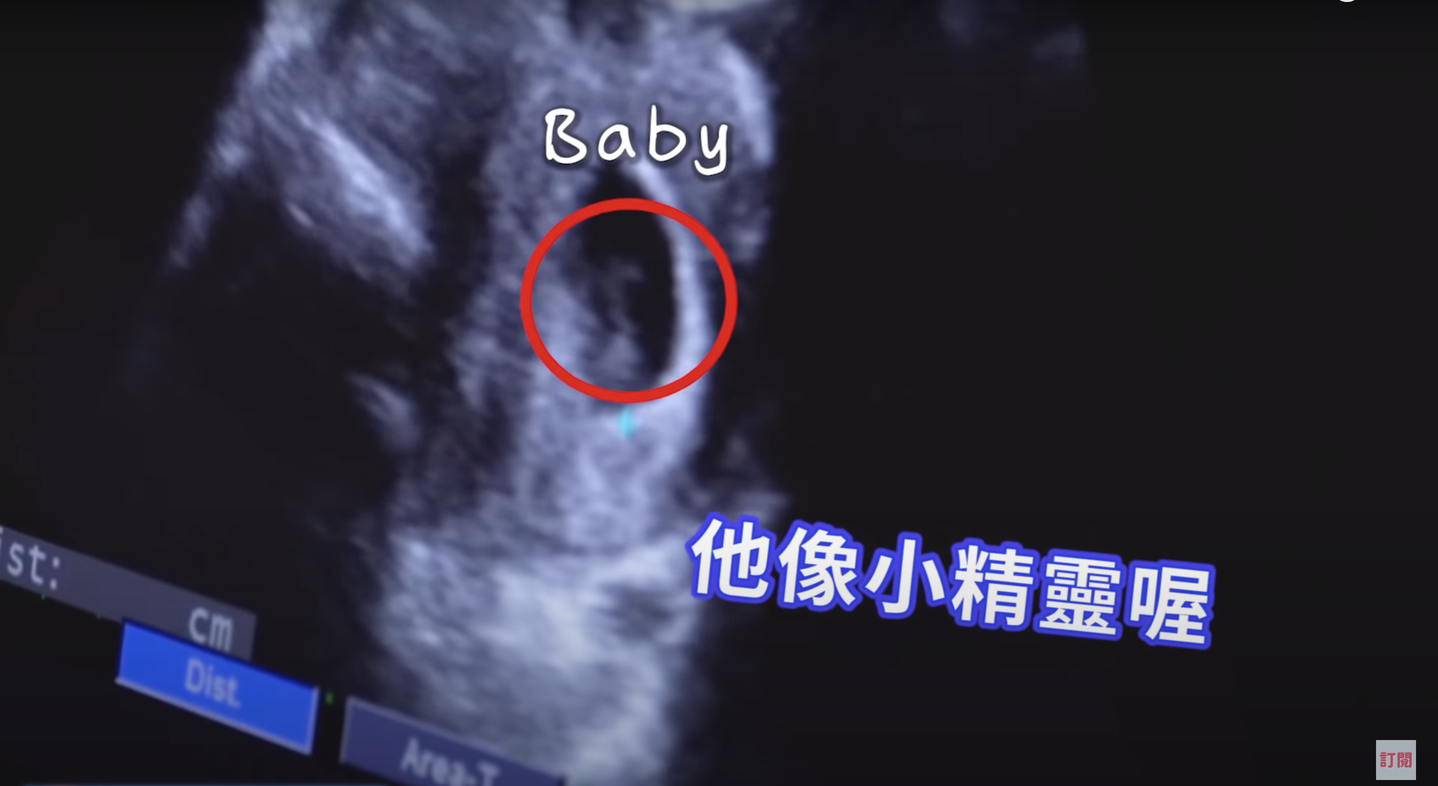 老公劉亮佐也難掩興奮,看著超音波中的寶寶影像直呼:「他(Baby)像小精靈喔!」(翻攝自《趙小僑女人說》Youtube)
