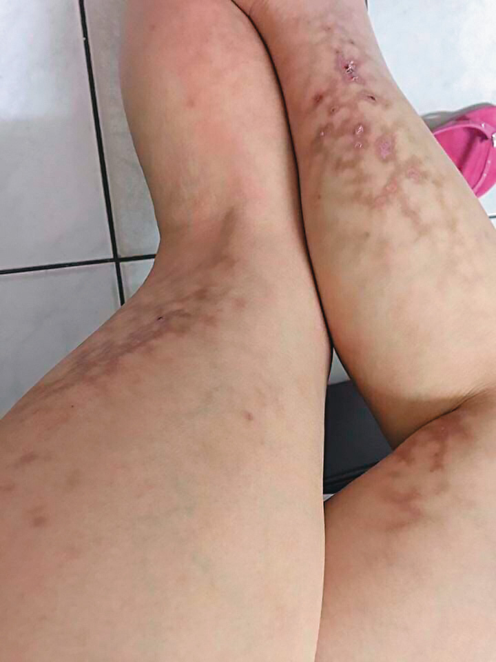 懷孕時，小雯不幸罹患妊娠高血壓，全身從臉到腳都布滿青斑。（讀者提供）
