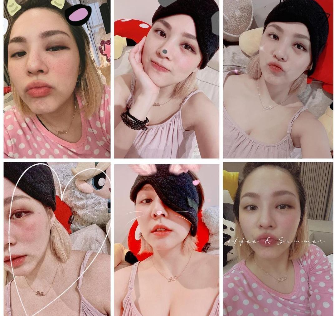 熊熊不小心摔倒掛急診,臉蛋腫了一大塊,濾鏡都遮不住。(翻攝自熊熊IG)