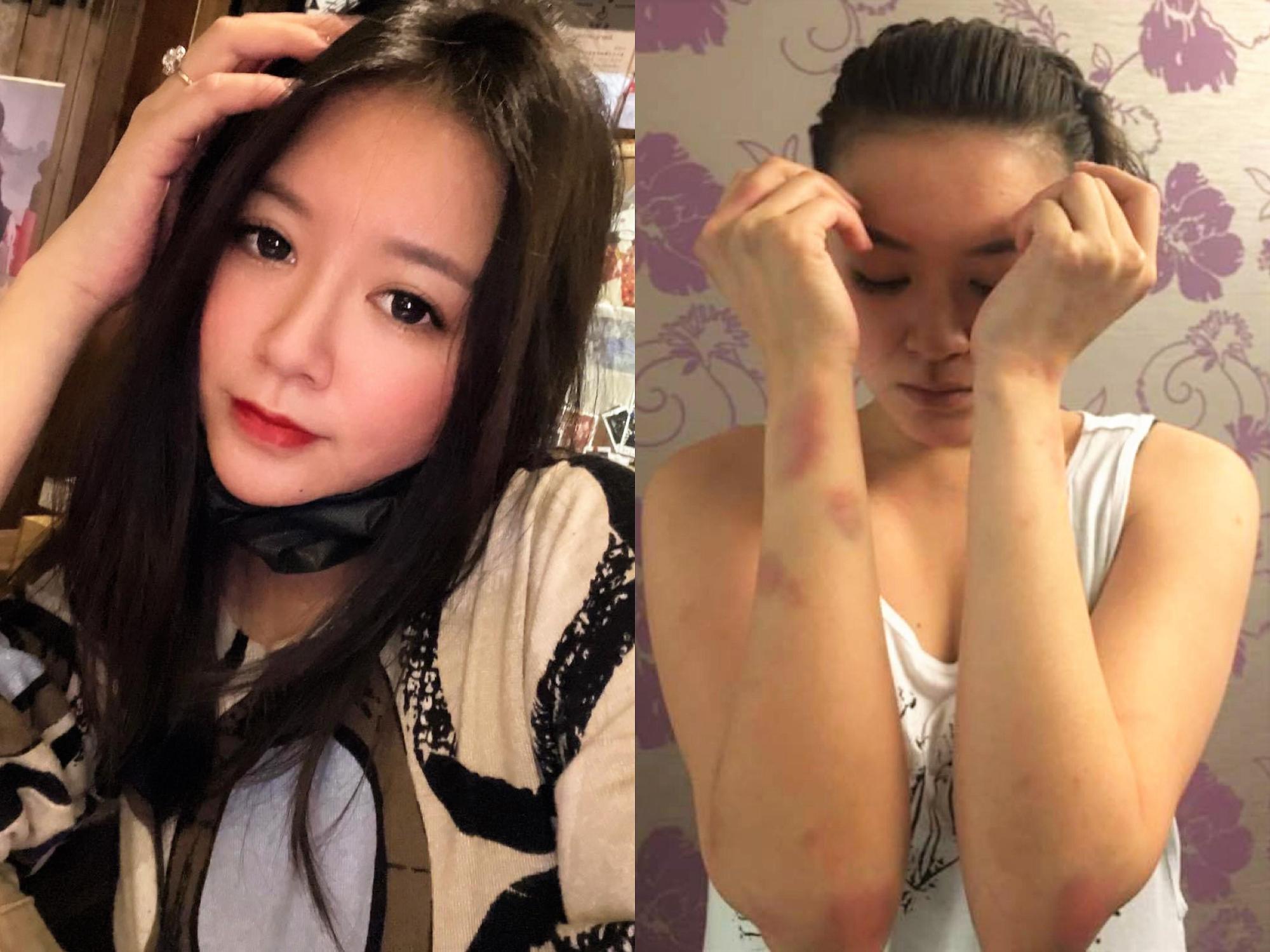 李妍瑾當年喝醉酒與計程車司機發生肢體衝突，事後還在臉書貼上自己全身遭毆傷的照片。（圖／翻攝自李妍瑾臉書）