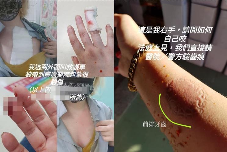前空姐曬出傷照，揚言要對婆婆和對簿公堂。（翻攝自臉書社團爆料公社）