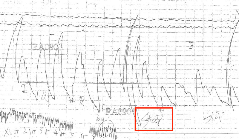 基於原理上的根本漏洞，測謊在美國、德國皆不被法院接受作為證據，我國司法院也已修法希望明定測謊不得作為證據，卻遭法務部反對，圖為測謊圖譜。
