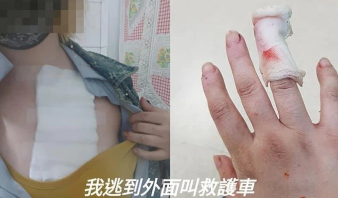 前空姐在臉書「爆料公社」po出婆婆咬她手臂的照片,指稱長期受到公婆霸凌。(翻攝畫面)