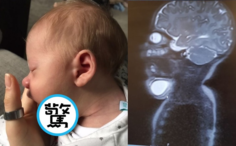 英國一名母親在產檢時發現寶寶長出「第2個下巴」。（翻攝自princehiro19 IG）