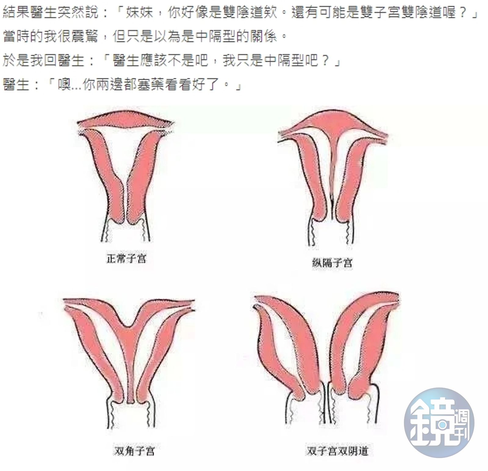 就醫發現神祕岔路雙陰道女嘆：敏感點都被「分隔島」蓋住- 鏡週刊Mirror Media