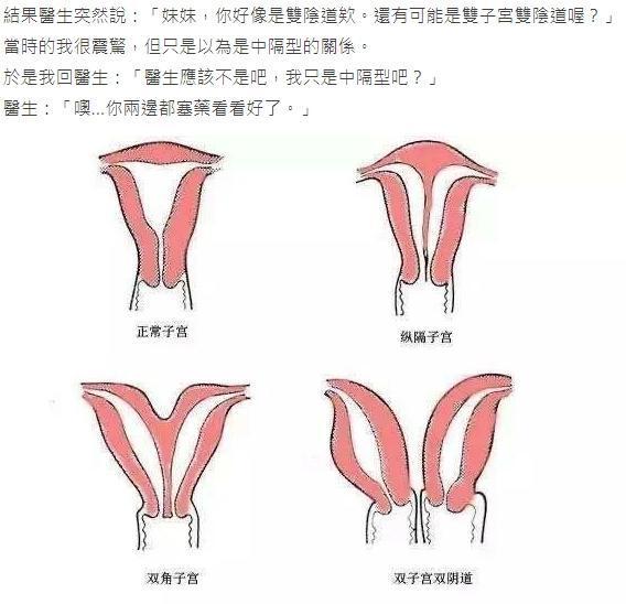 為陰道疾病就醫後,這名女網友被婦產科醫師判定可能是「雙子宮雙陰道」。(翻攝自Dcard)
