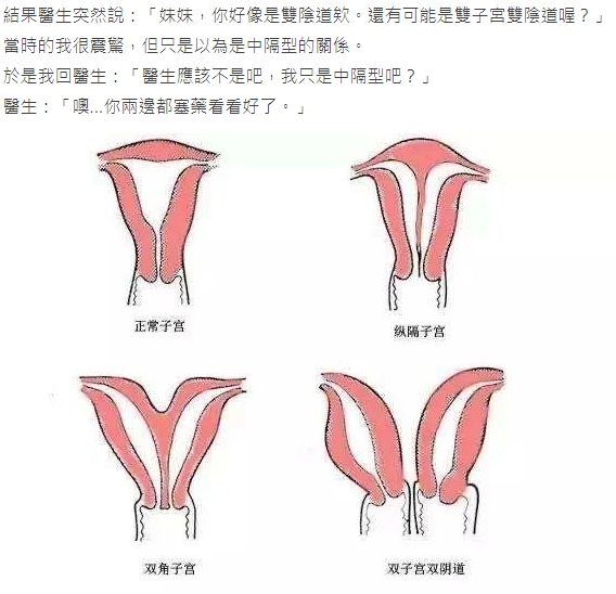 為陰道疾病就醫後，這名女網友被婦產科醫師判定可能是「雙子宮雙陰道」。（翻攝自Dcard）