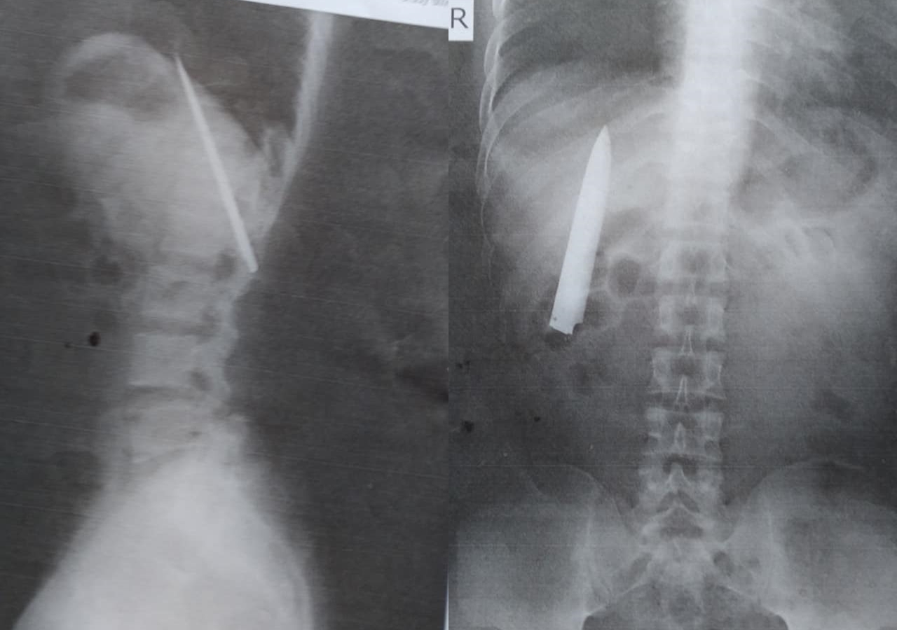 菲律賓一名男子胸口藏刀10公分。（翻攝自Kent Ryan臉書）