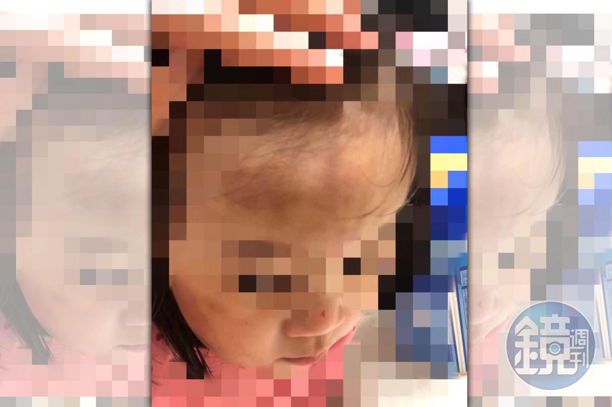 A先生指控女兒送給保母託育後，額頭出現大面積瘀傷。（讀者提供）