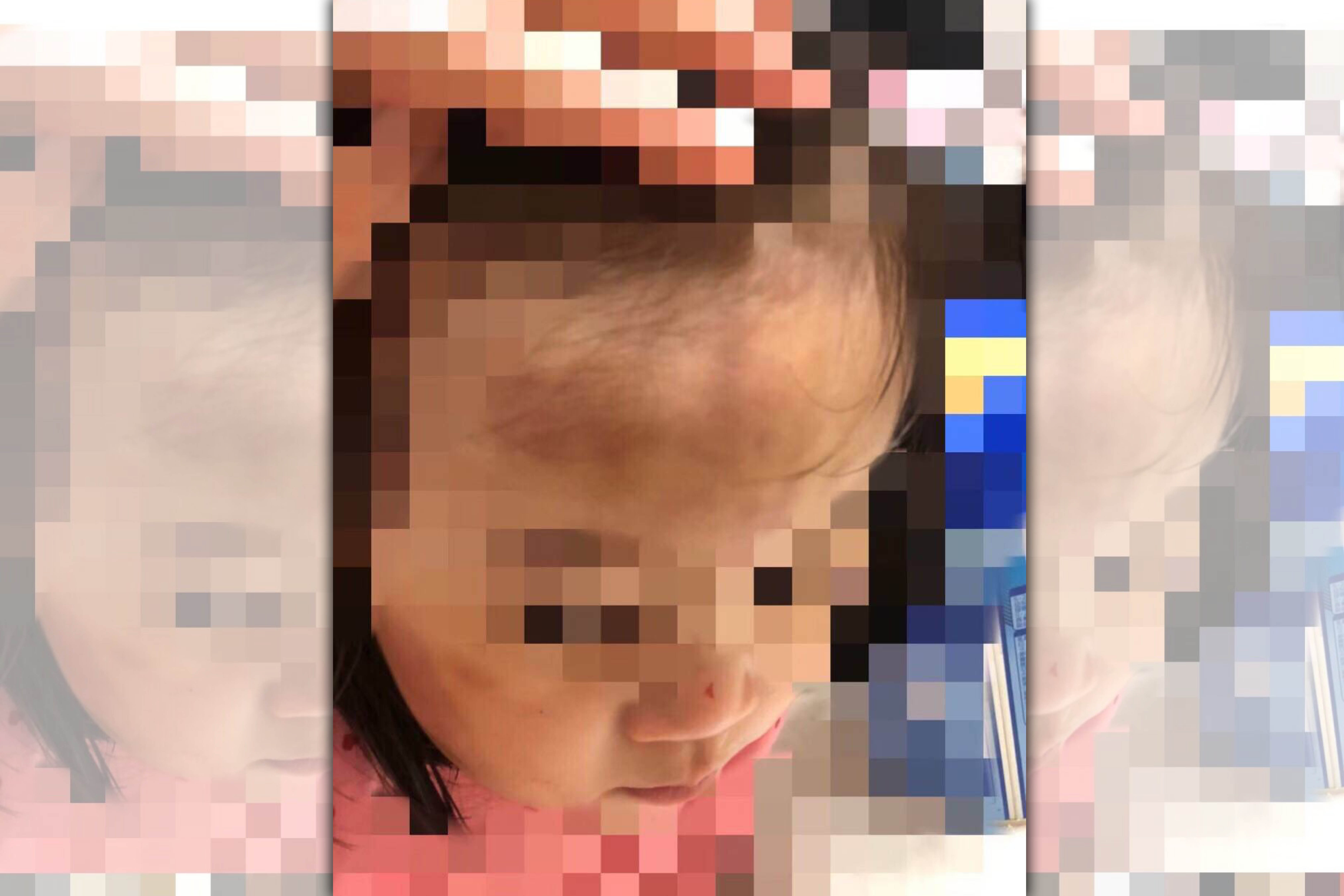 A先生指控女兒送給保母託育後，額頭出現大面積瘀傷。（讀者提供）